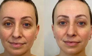 Neveskin facial result